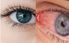 眼角发痒是怎么回事 用眼不卫生也会眼角发痒吗