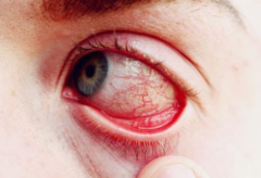 眼角发痒是怎么回事 怎么预防眼角发痒