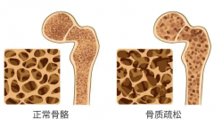 女性补钙有哪些好处 缺钙会造成骨质疏松吗