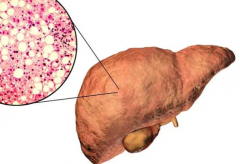 护肝要怎么做 坚持适合自己的小运动可治疗脂肪肝