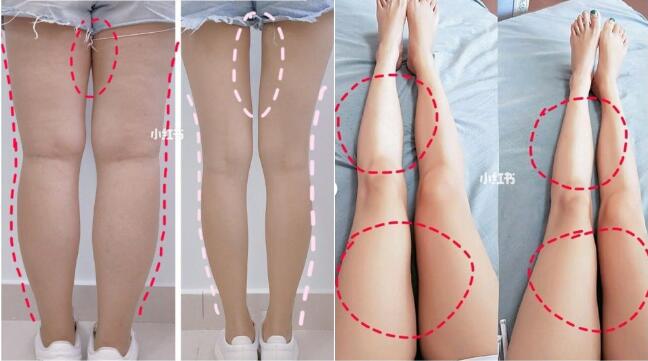 腿粗还分脂肪型、水肿型 不同腿搭配对应瘦腿方法