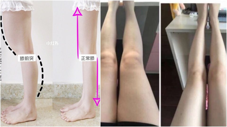 腿粗还分「脂肪型、水肿型」？ 不同腿搭配不同运动，1周速成腿精～