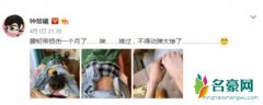 钟楚曦晒照称腰受伤 直呼不得动弹太惨了