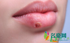 嘴唇上长水泡是什么原因 如何预防嘴唇起泡