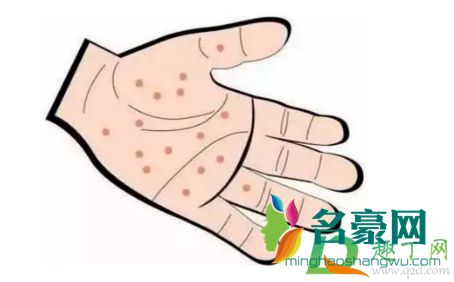 汗疱疹不管它会好吗4