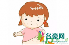 痱子怎么消除小妙招 痱子是怎么引起来的