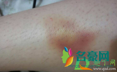 脸上碰的淤青怎么快速消除3
