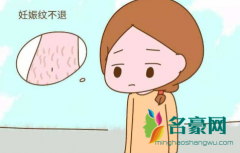 妊娠纹不退怎么去除