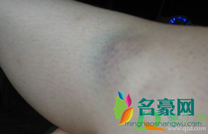 棍子打的红肿紫怎么消1