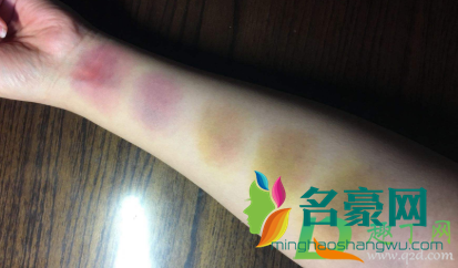 棍子打的红肿紫怎么消4
