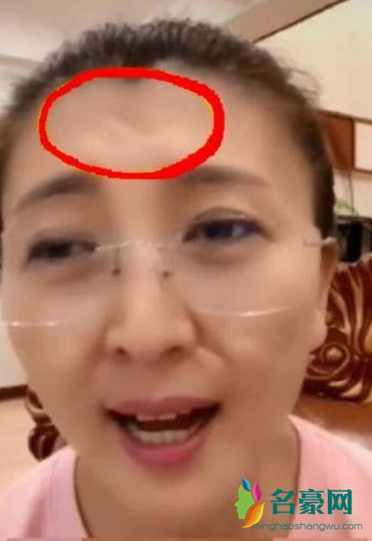闫学晶额头伤疤明显