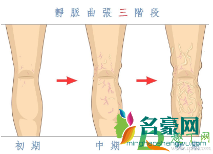 静脉曲张需不需要做手术2