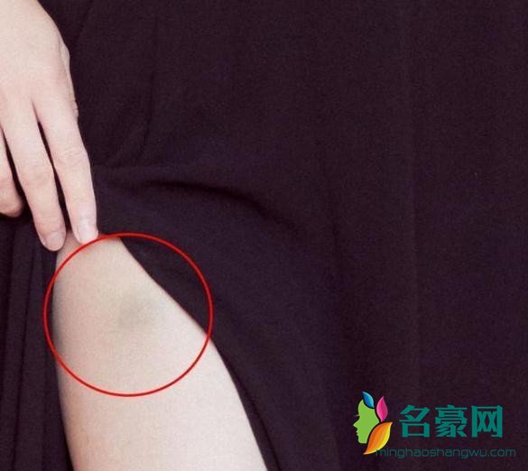 迪丽热巴大腿淤青