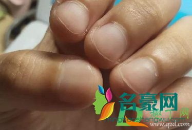 指甲盖掀翻出血怎么办3