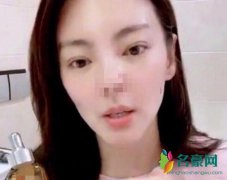 张雨绮疑似整容失败 网友：鼻子很不对头啊