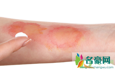 烫伤用什么药3