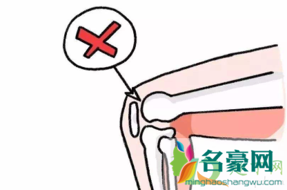 膝盖骨折要打钢钉吗2