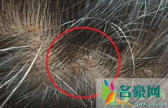 后脑勺头皮长疙瘩是什么原因 怎么预防头皮长痘