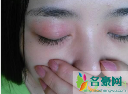 眼皮发痒红肿是咋回事3