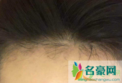 植发可以维持多久呢4
