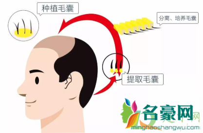 植发可以维持多久呢3