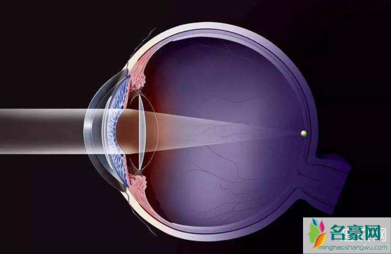 近视激光手术要求 近视激光手术风险