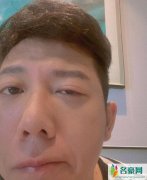 胡海泉右眼发炎红肿 吃力半睁右眼尽显疲惫十足