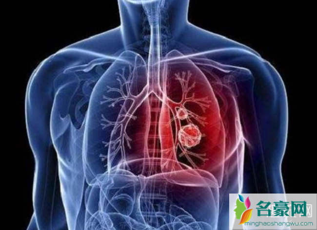 肺炎和感冒的症状区别 新型冠状病毒肺炎怎么预防