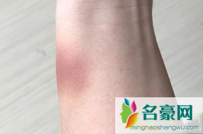 磕碰淤青肿起来怎么处理2