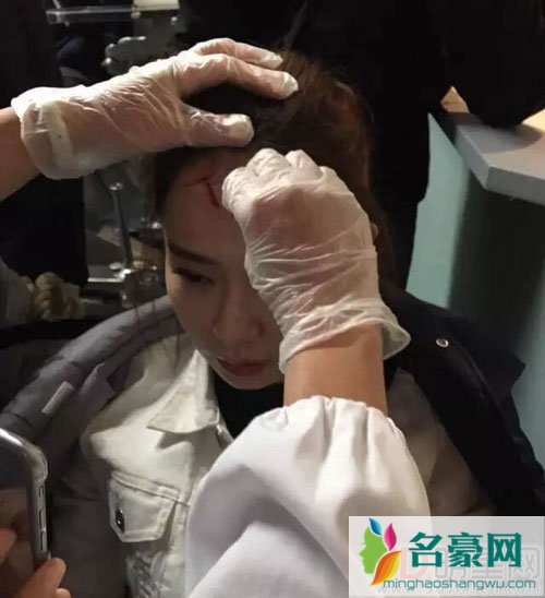 戚薇谈拍追捕受伤 额头留疤更有七哥气质