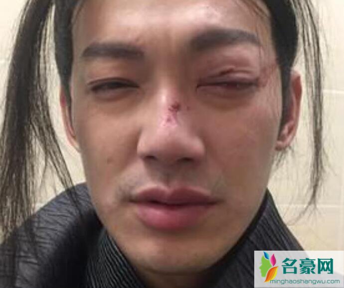 威廉拍戏出意外 
