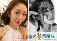 艺人蔡允洁晒满脸血照吓坏网友 发文自责不是想吓