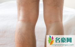 老寒腿是什么症状 治疗老寒腿的中成药有哪些