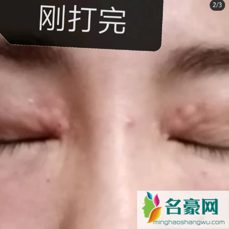 丽珠兰白盒打完鼓包正常吗3