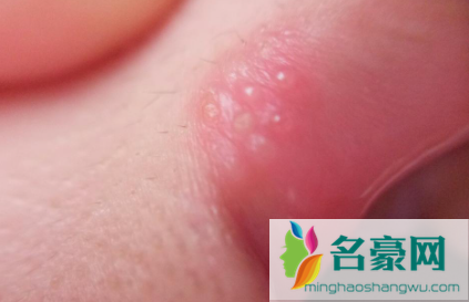烂嘴角是真菌感染吗3