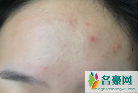 痤疮为什么不建议吃米诺环素3