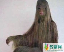 世界上体毛最长的女人艾米丽苏珊（浑身都是毛被人