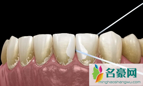 抠牙结石工具叫什么2