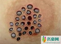 莲蓬乳是什么（超恶心密集恐惧症图片-重口味慎入