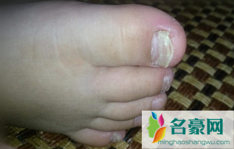 灰指甲需要每天去刮吗3