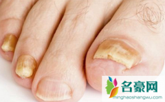 灰指甲初期样子图片轻微 灰指甲的初期症状