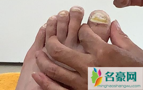 得了灰指甲千万别去修脚店1