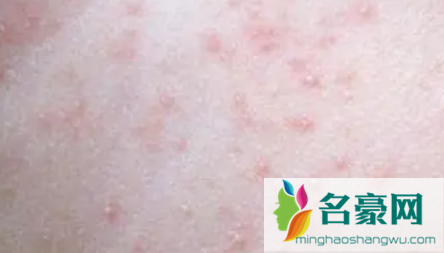 宝宝痱子怎么快速消除止痒3