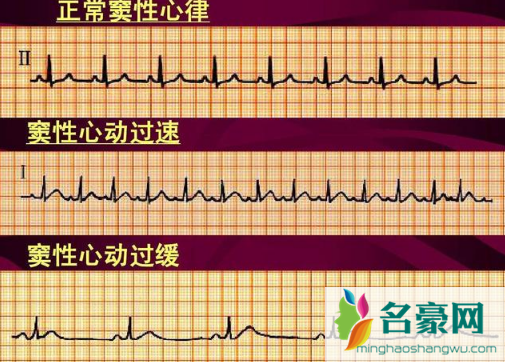 窦性心律不齐是心脏病早期吗2