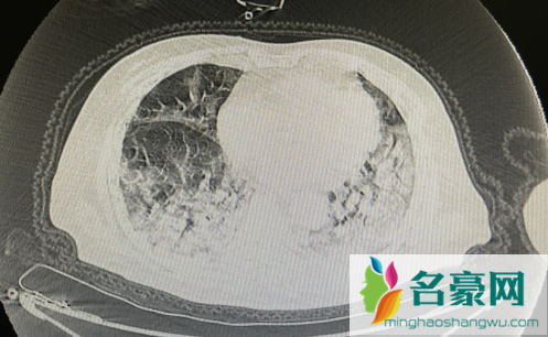 肺炎最严重是不是白肺2