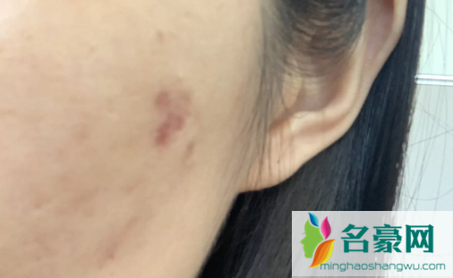 为什么照镜子看不到痘印拍照就有1