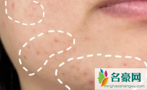 为什么照镜子看不到痘印拍照就有2