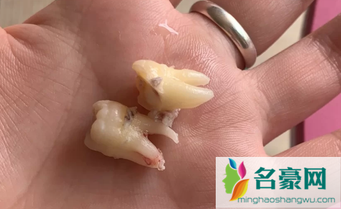 为什么有的牙齿有2个牙根有的没有3