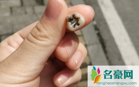 拔了一颗大牙后悔死了什么说法2